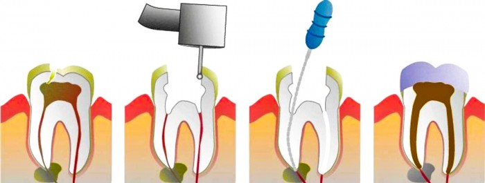 Endodoncia endodoncia